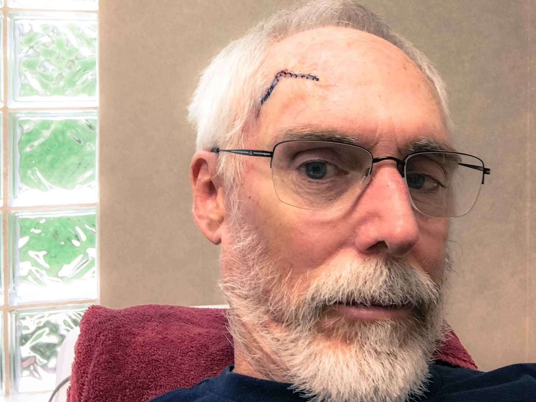 skin cancer forehead